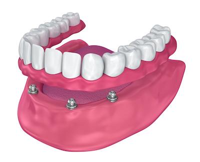 Dentures being put on teeth, winston-salem nc