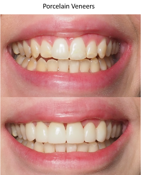 Before and after photo of veneers, winston salem nc