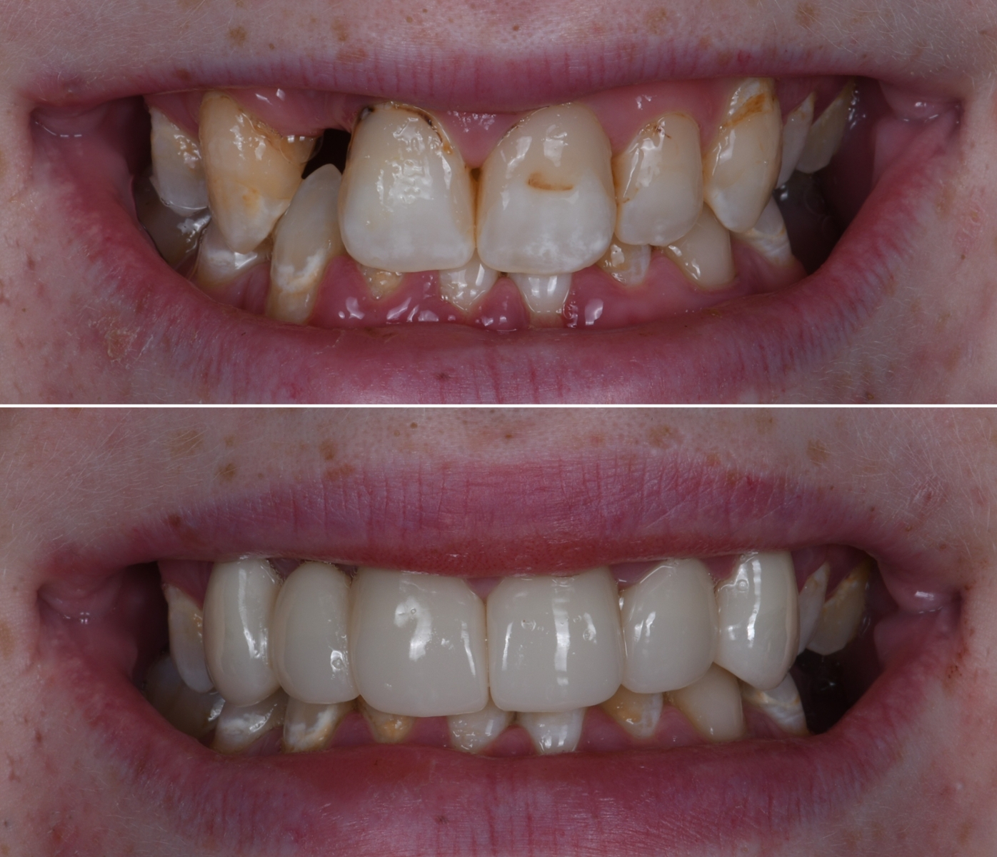 "Before and after smile transformation showing chipped, discolored teeth restored with natural-looking crowns.