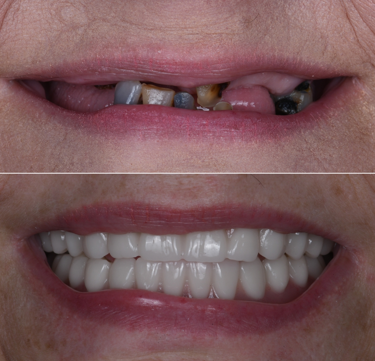 Before and after full arch implants