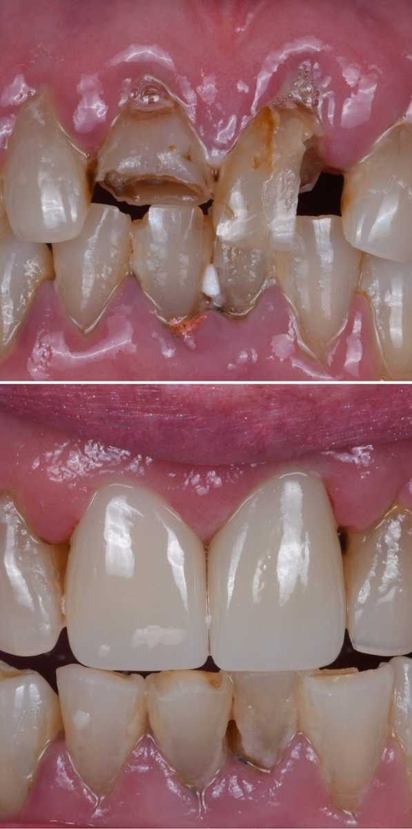 Before and after dental crowns