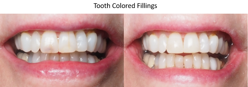 Before and after photos of tooth colored fillings, winston salem nc