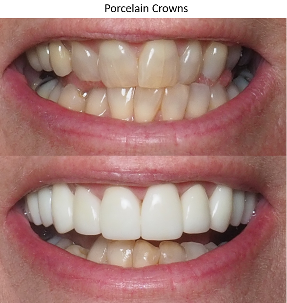 Before and after photo of porcelain crowns, winston salem nc