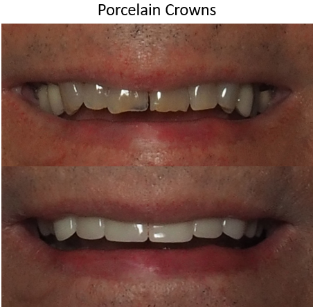 Different photo of before and after dental crowns, winston salem nc