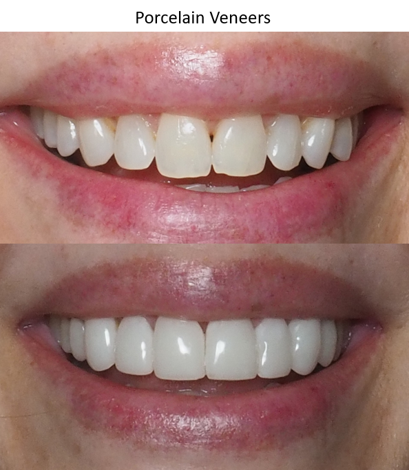 Close up of smile before and after porcelain veneers, winston-salem nc