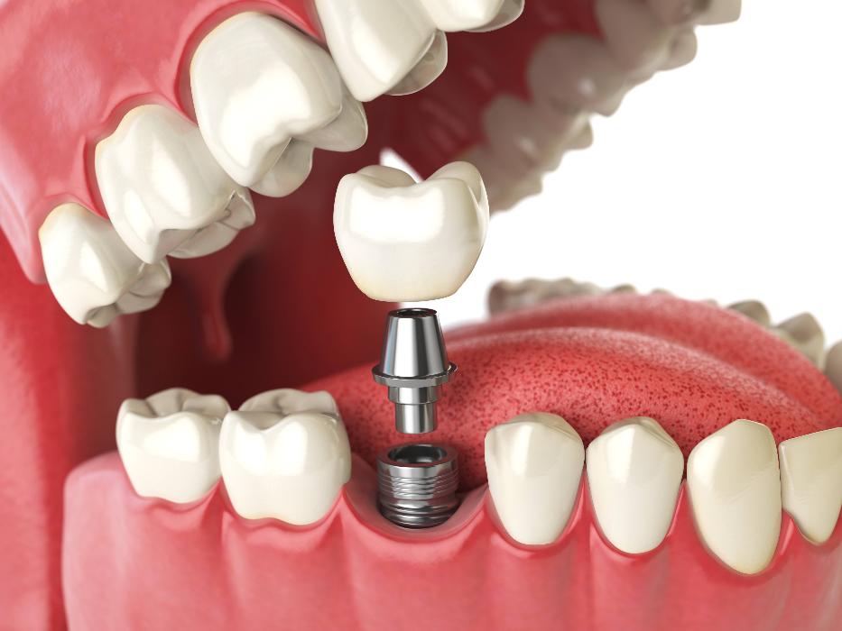 rendering of dental implant in jaw | dental implants winston salem nc