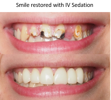Before and after photos of iv sedation, winston salem nc