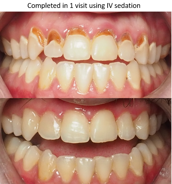 Different before and after photo of iv sedation use, winston salem nc
