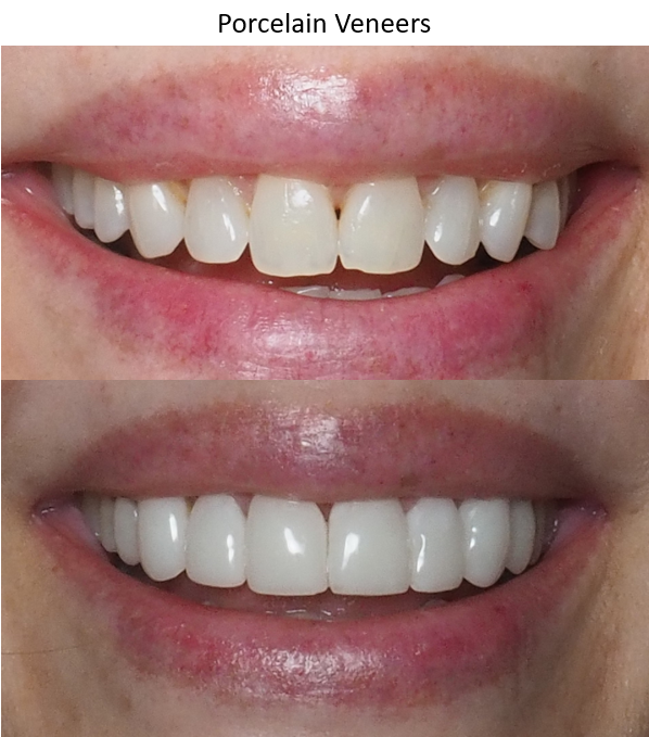 woman smiling, before and after photo of porcelain veneers, winston salem nc