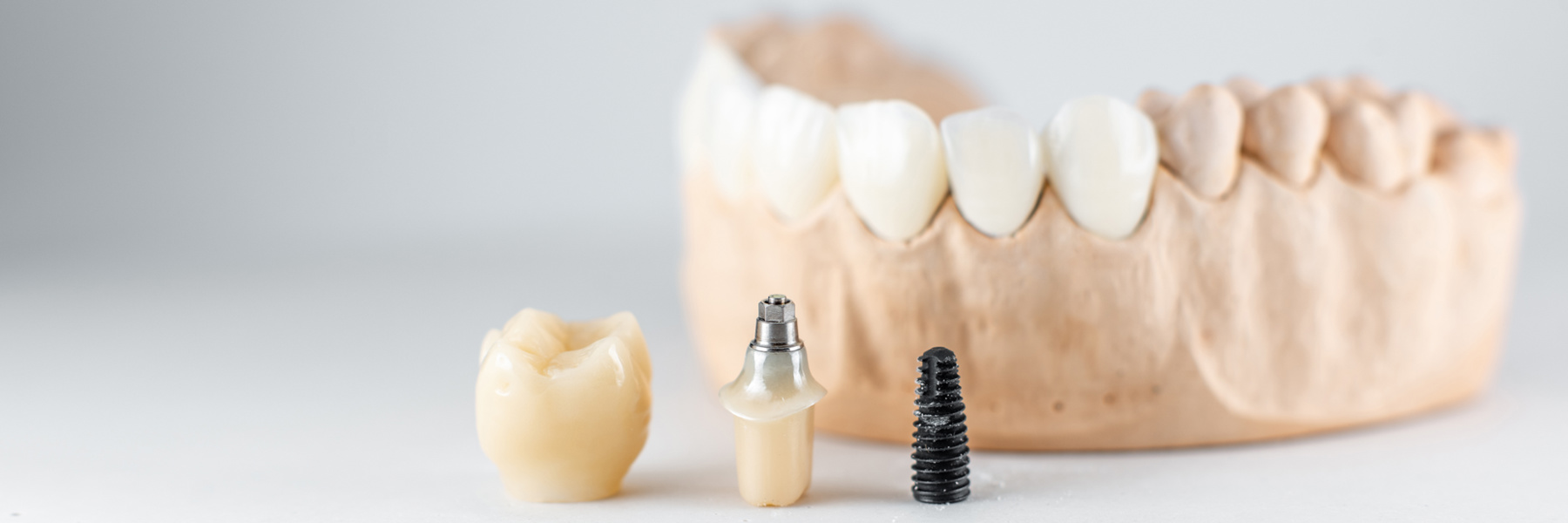 Dental implant components including crown, abutment, and titanium screw beside a full arch jaw model