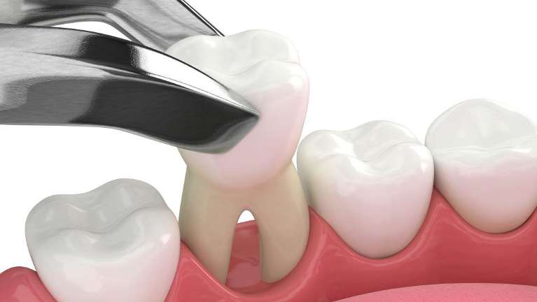 Image depicting how a tooth extraction works, winston-salem nc