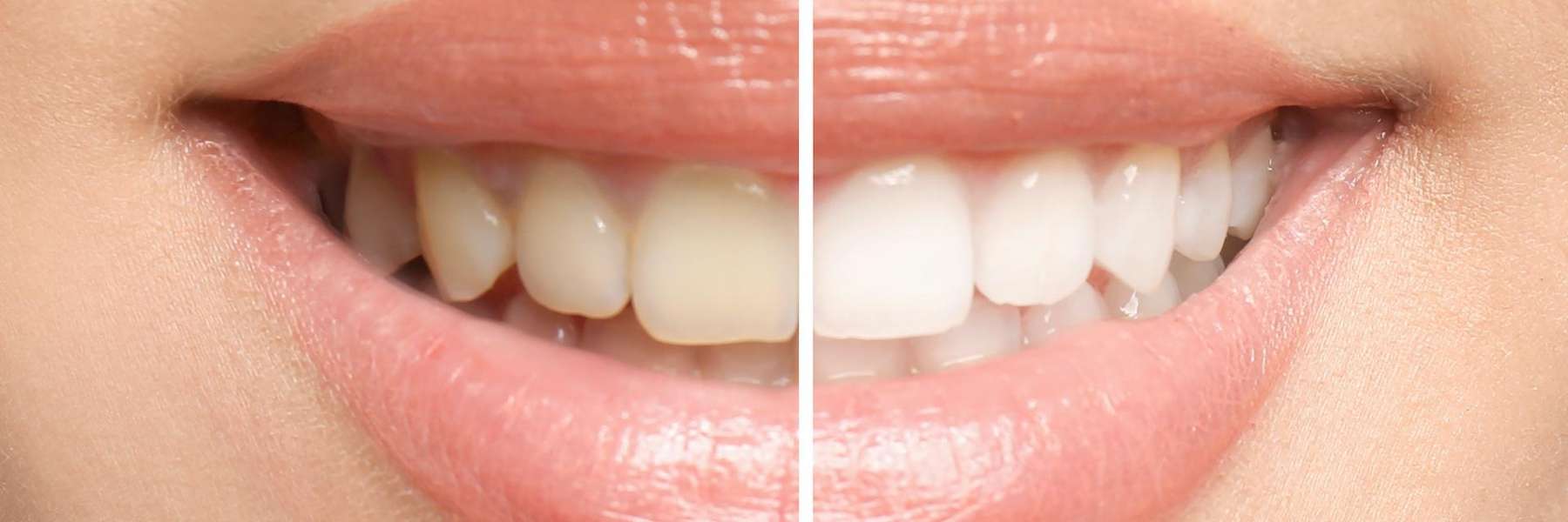 Before and after image of teeth using teeth whitening, winston-salem nc