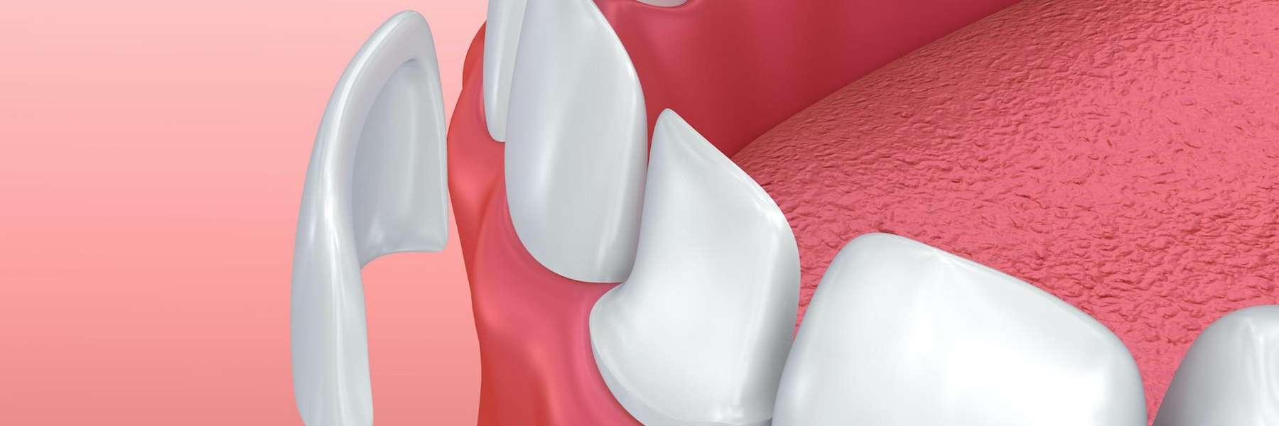 Before and after of composite dental veneers by Dr. Blake Nelson in Winston Salem
