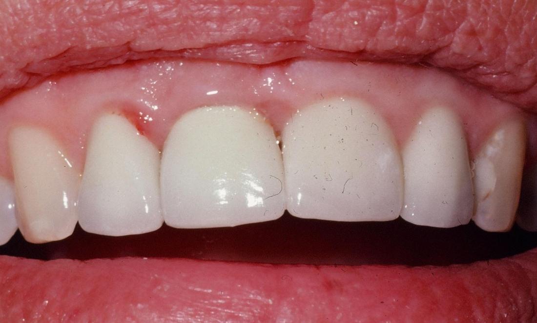 After cosmetic dental crown in Winston Salem