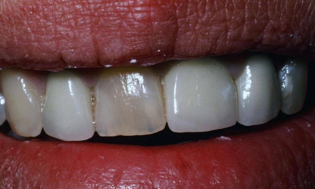 Before cosmetic dental crown