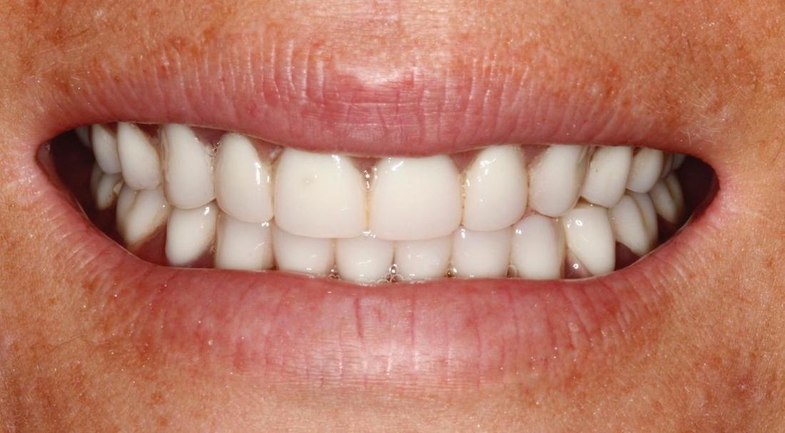 After complete dentures in Winston Salem