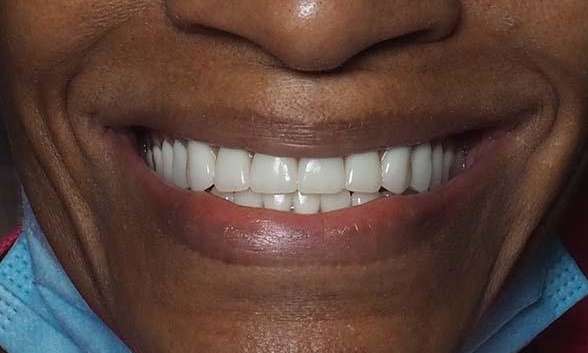 Close up of black persons after before dentures in winston salem