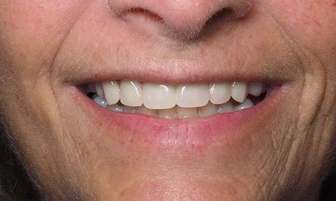Close up of mouth after dentures winston salem