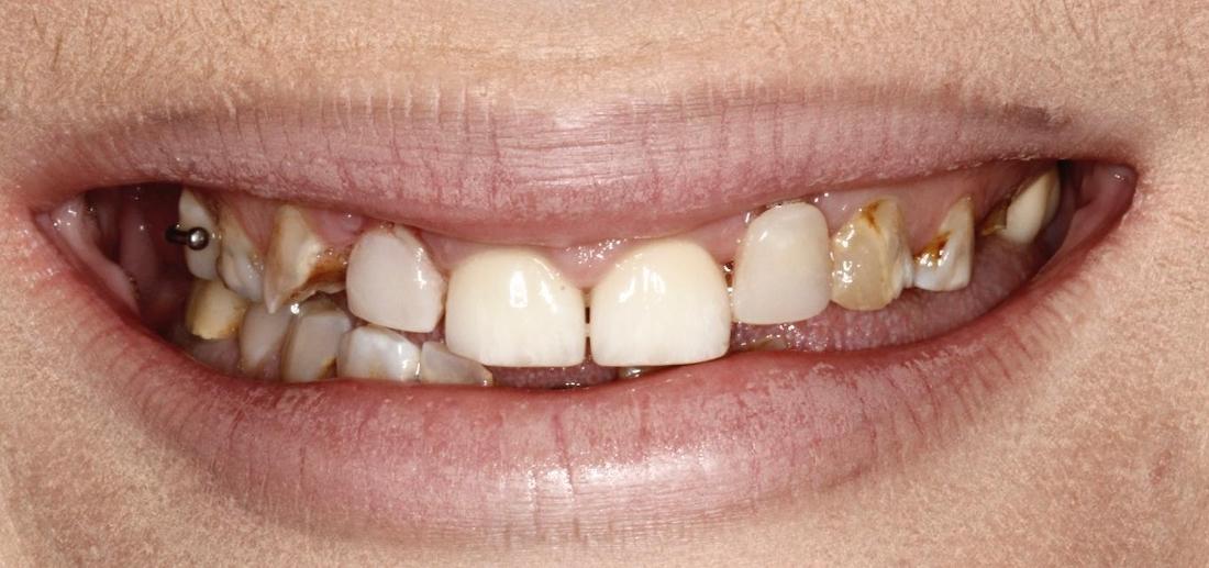 Before complete dentures in Winston Salem