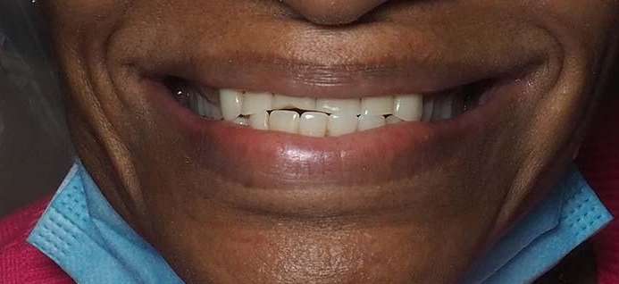 Close up of black persons mouth before winston salem dentures