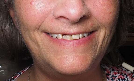 Close up of mouth before winston salem dentures