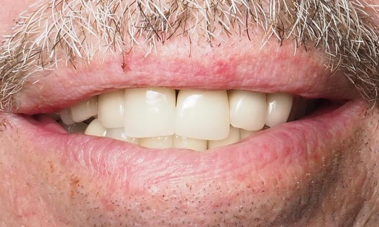 Dental-Implant-After-Image