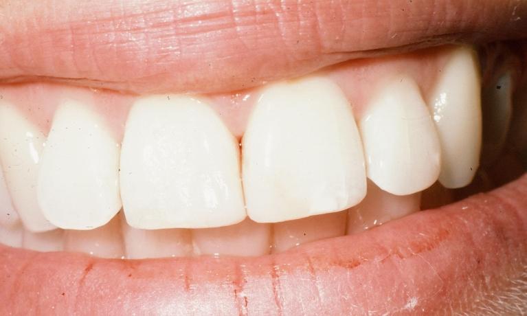 Palmetto Dental Associates — Tooth-colored Fillings