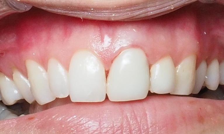 Porcelain-Dental-Crowns-After-Image