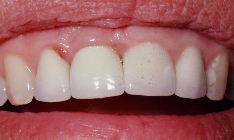 Porcelain-Dental-Crowns-After-Image