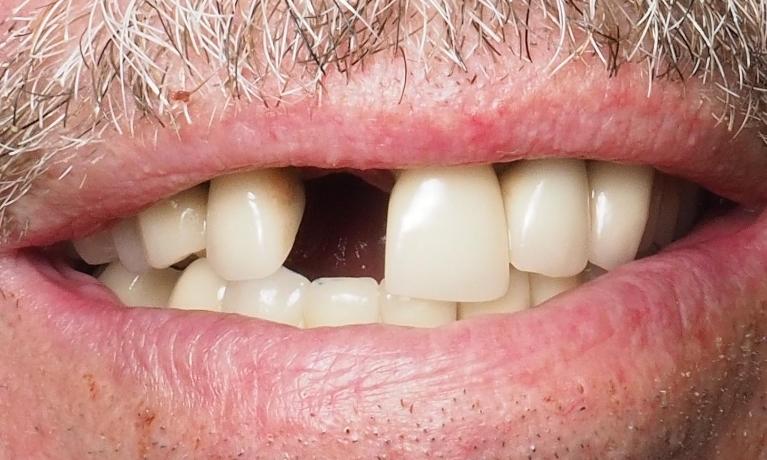 Dental-Implant-Before-Image