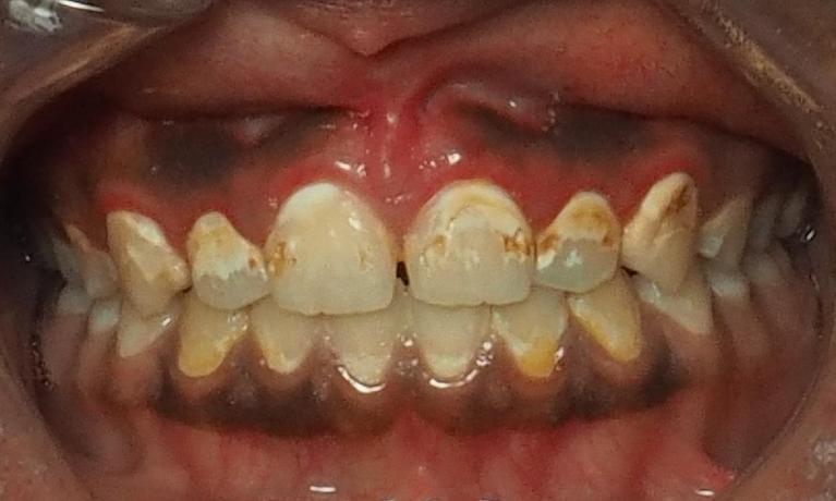 Repair-Your-Smile-With-Composite-Veneers-Before-Image