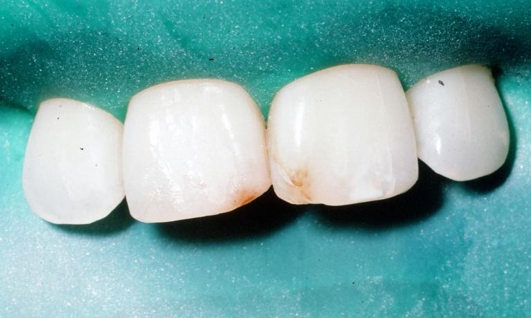 Tooth Colored Fillings Gallery - Hosner Family Dentistry