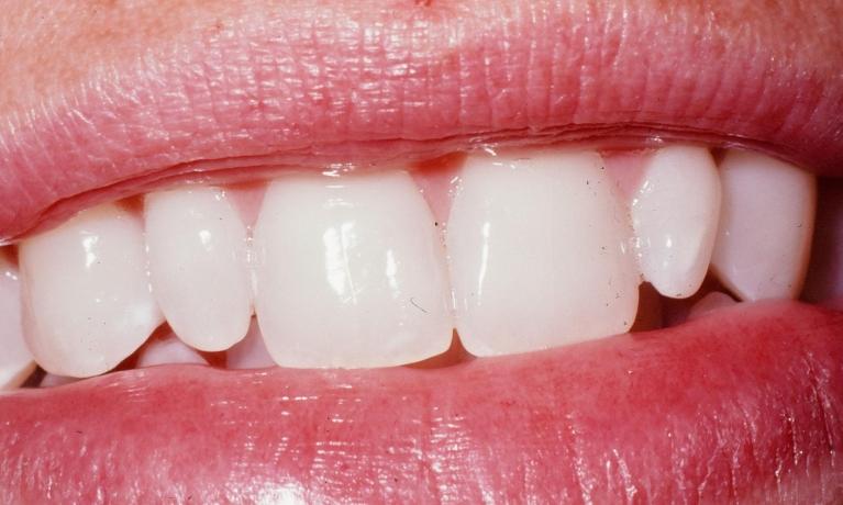 Esthetic-Dental-Fillings-Before-Image