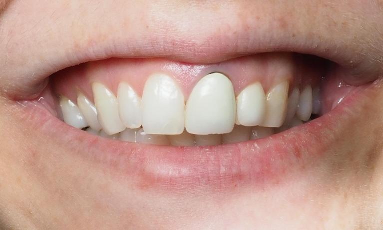 Porcelain-Dental-Crowns-Before-Image