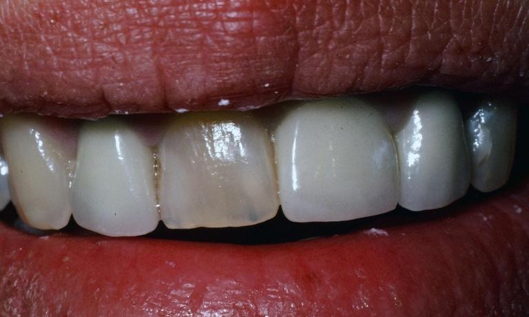 Porcelain-Dental-Crowns-Before-Image