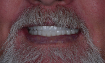 After treatment - A New Smile with Full Arch Dental Implants