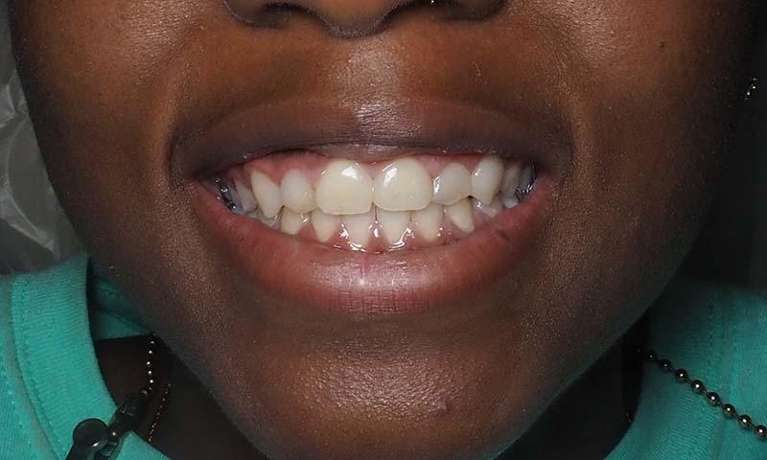 composite veneers winston salem- after photo
