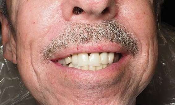 Antieor-implant-After-Image