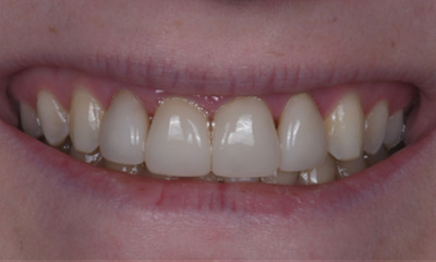 dental crowns in Winston Salem, NC- After Photo