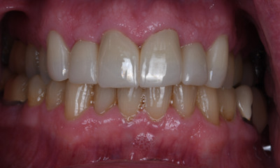 Custom dental crowns- after photo