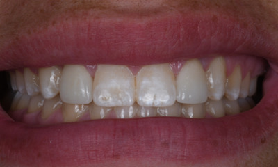 dental crowns in Winston Salem, NC- After Photo