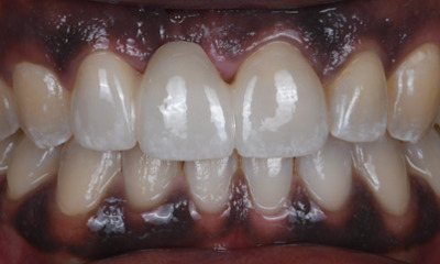 dental emergency- after photo