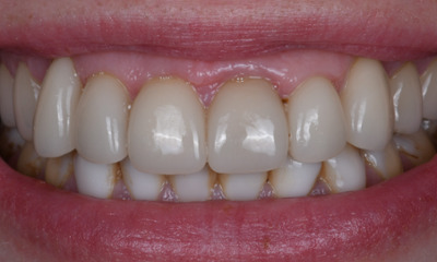 After treatment - Replacing 12 Outdated Veneers for a Refreshed, Age-Appropriate Smile