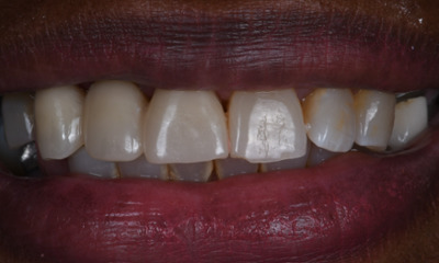 dental bridge in winston salem- after photo