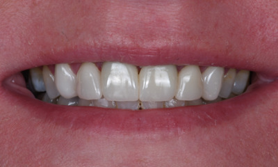 After treatment - Replacing Old Metal Crowns with 6 New Custom Crowns