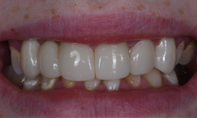 dental crowns in Winston Salem, NC- After Photo