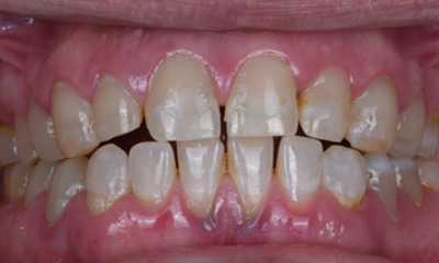 After treatment - Restoring a Healthier, More Confident Smile with Composite Fillings