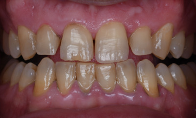 sedation dentistry case in Winston Salem, NC- After Photo