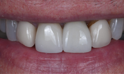 implants in winston salem, after photo