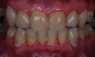 dental fillings in Winston Salem, NC- After Photo